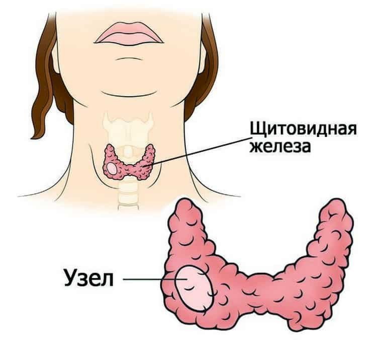 Аутоиммунный тиреодит: что делать, если вам поставили этот диагноз